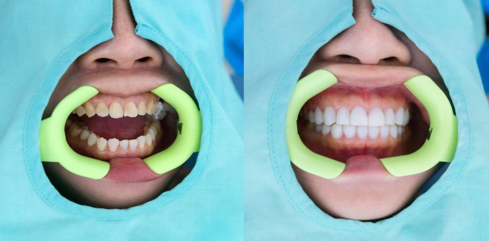 4 Reasons Why Millennials Prefer Smile Makeover