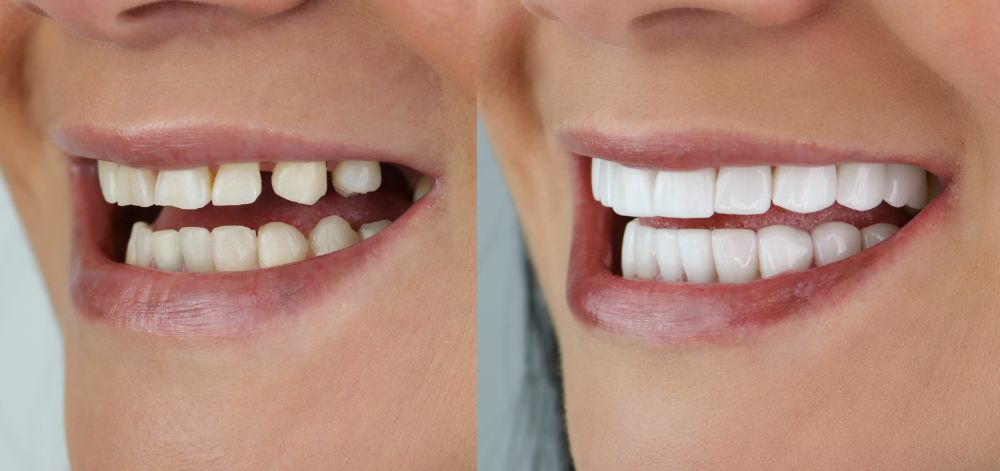 5 Smile Makeover Benefits For Your Professional Career