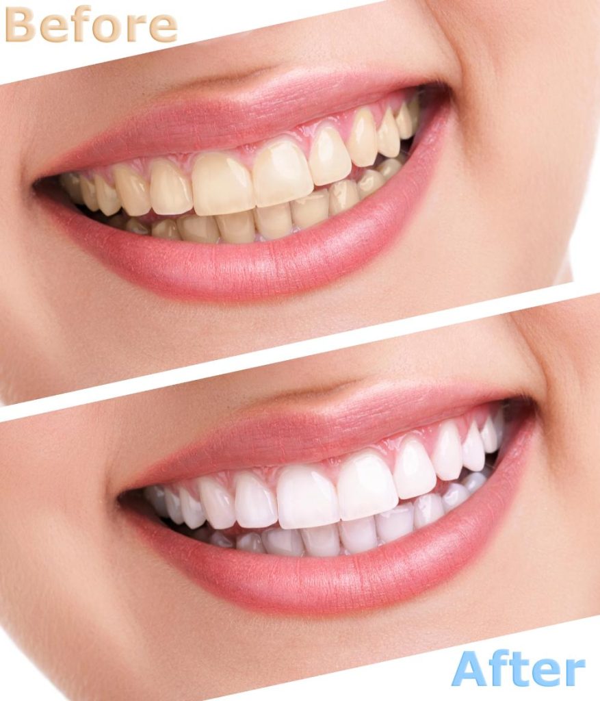 professional teeth whitening