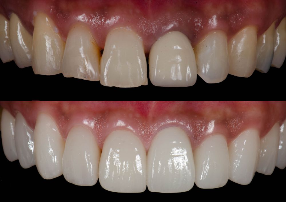 A Guide To Smile Makeover Care