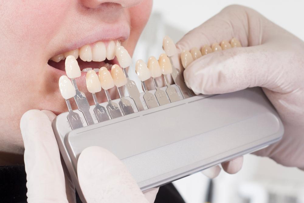 A Guide To The Different Types Of Veneer Preparation