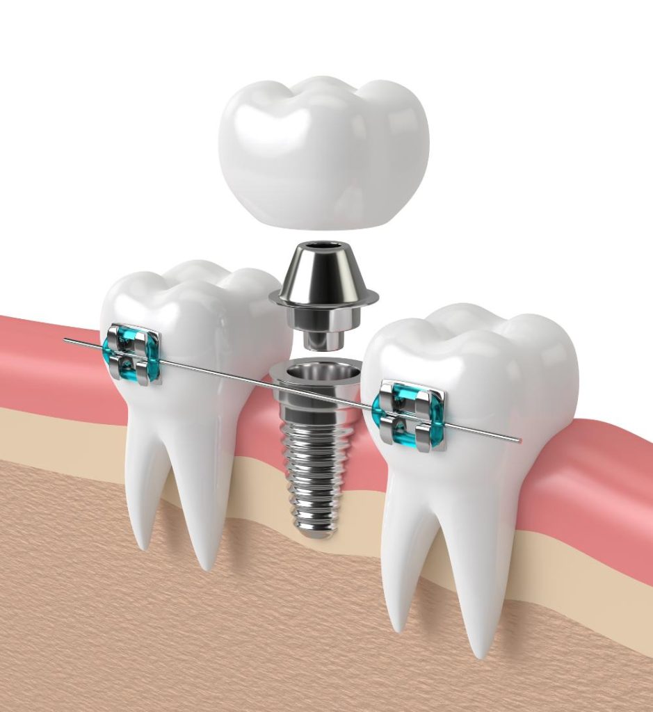 Dental Implants