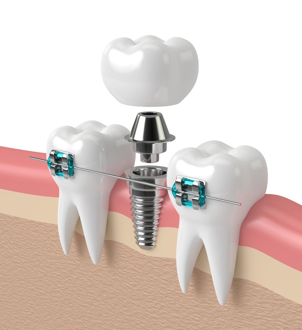 Alternatives To Dental Implants: What Are Your Choices?