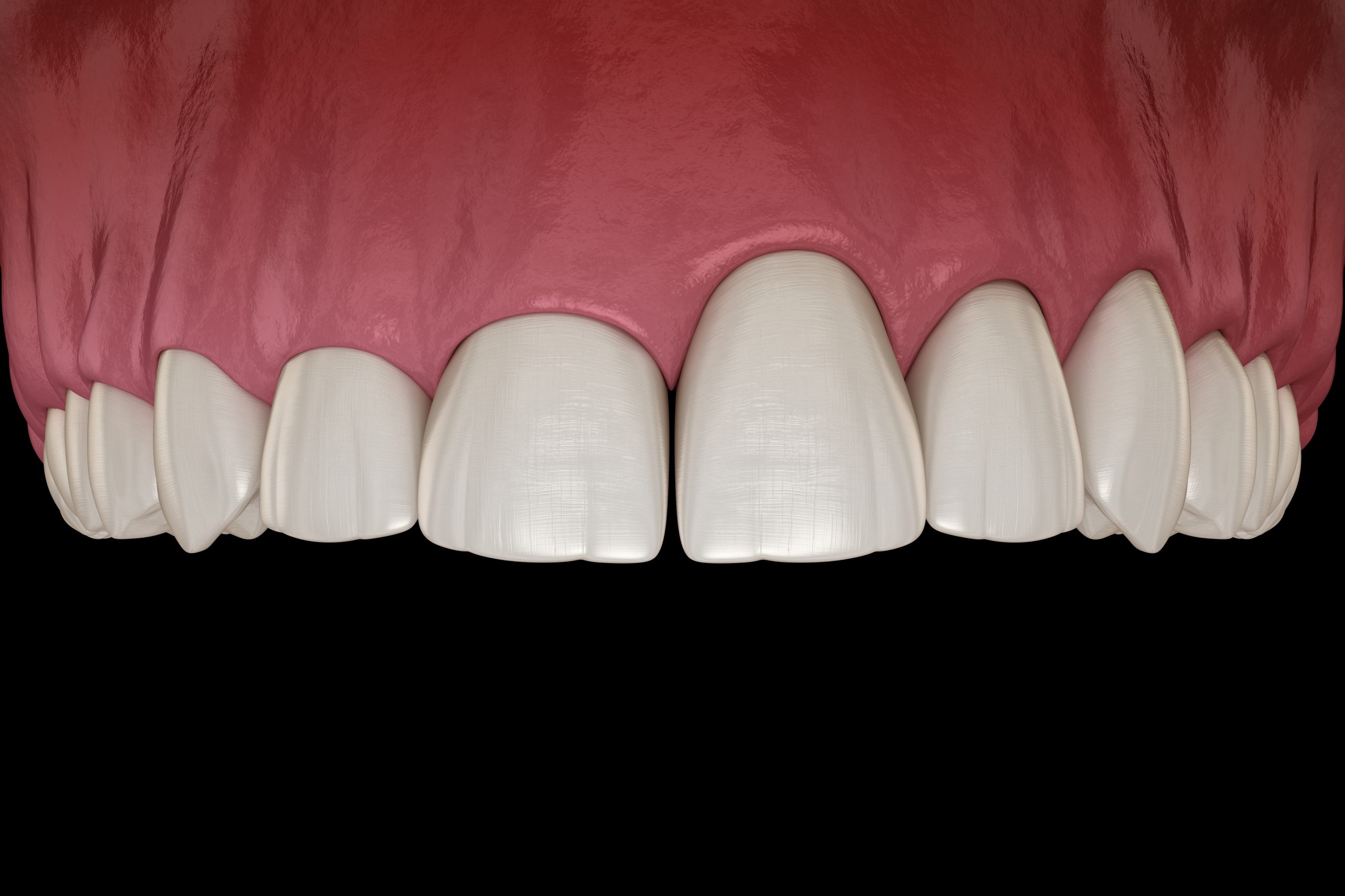tooth contouring