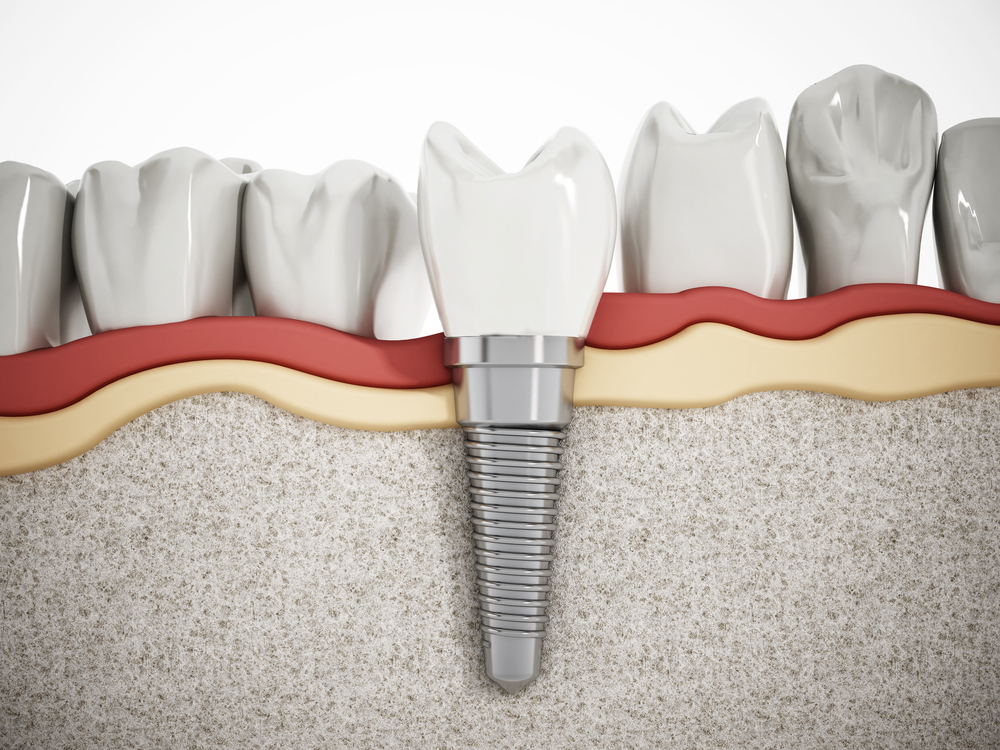 Are Dental Implants Painful? The Truth Revealed