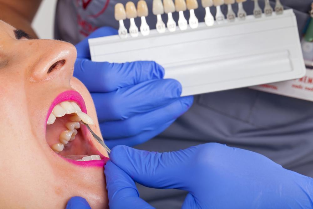 Are Veneers Permanent