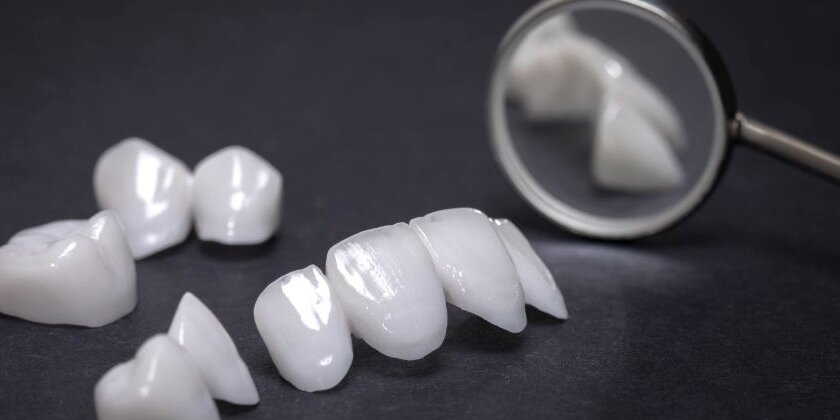 Porcelain Veneers