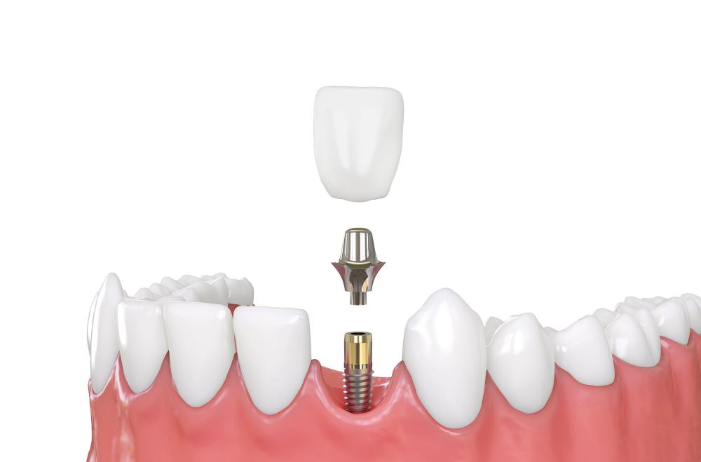Are There Any Dental Implant Side Effects?