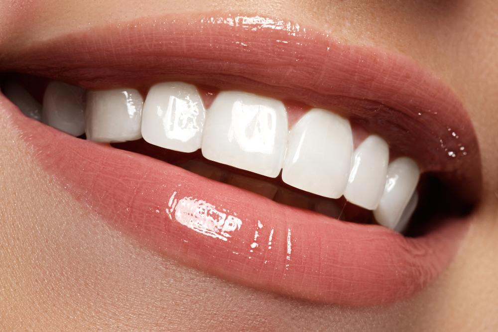 bad veneers vs. good veneers
