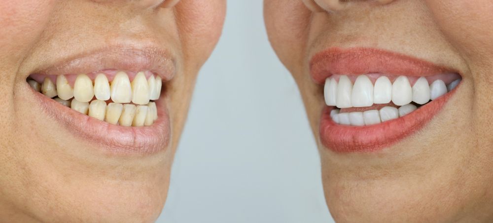 Before And After Smile Makeover: How Restoring A Perfect Smile Improves Your Mental Health