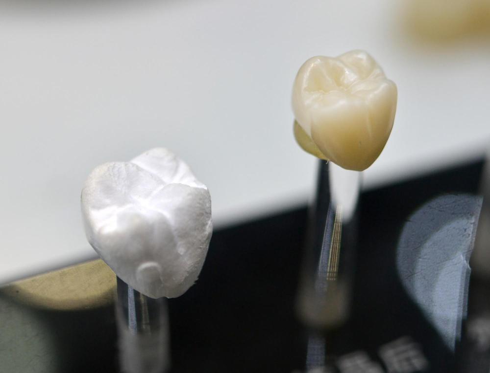Best Dental Crown Material For Molars: Which Option Lasts Longest?