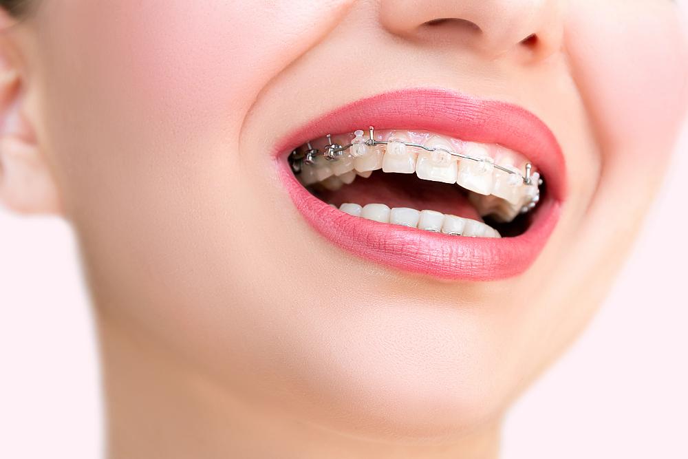 Braces Aren’t Just For Kids: Exploring Adult Orthodontics