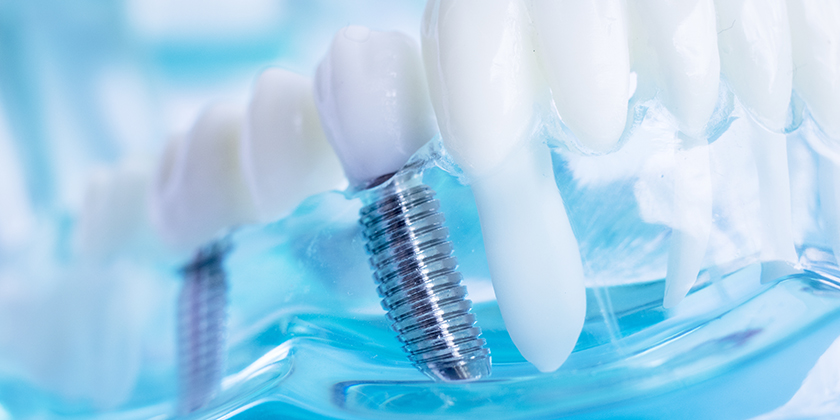 Busting Myths About Dental Implants