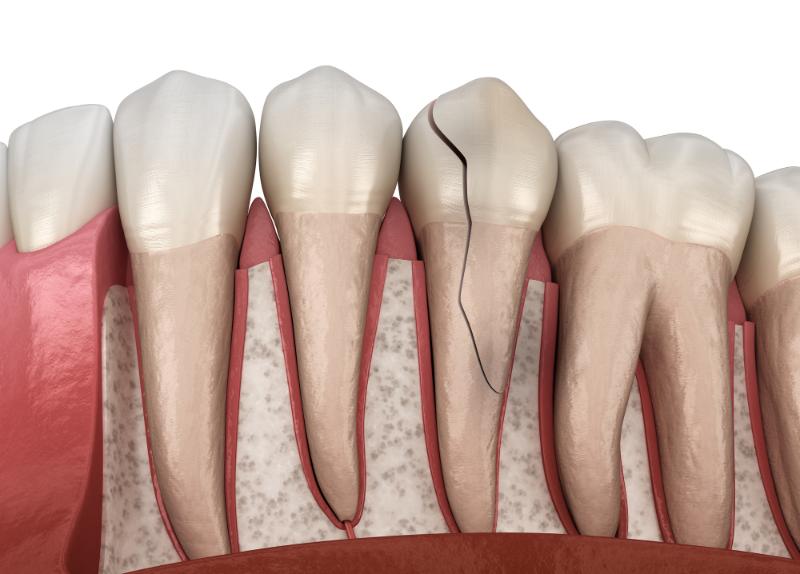 Can A Cracked Tooth Heal On Its Own?