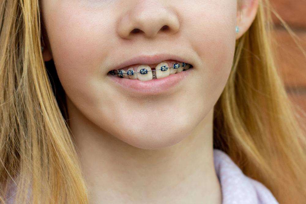 Can Braces Close a Missing Teeth Gap?
