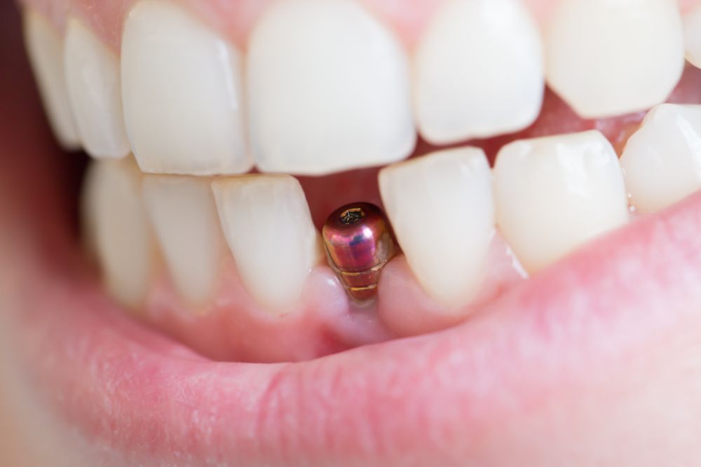 Can Dental Implants Fix The Shape Of Your Face?