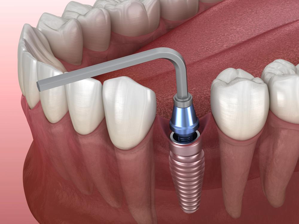 can diabetics get dental implants
