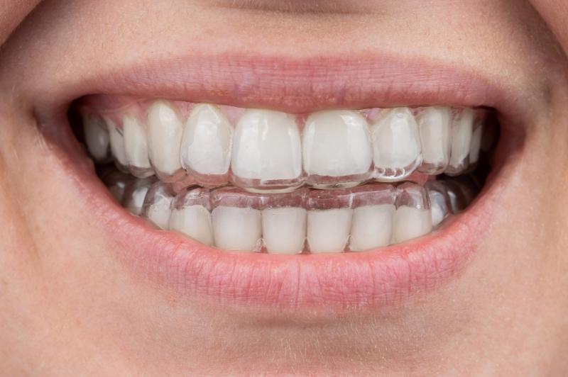 Can You Chew Gum With Invisalign?