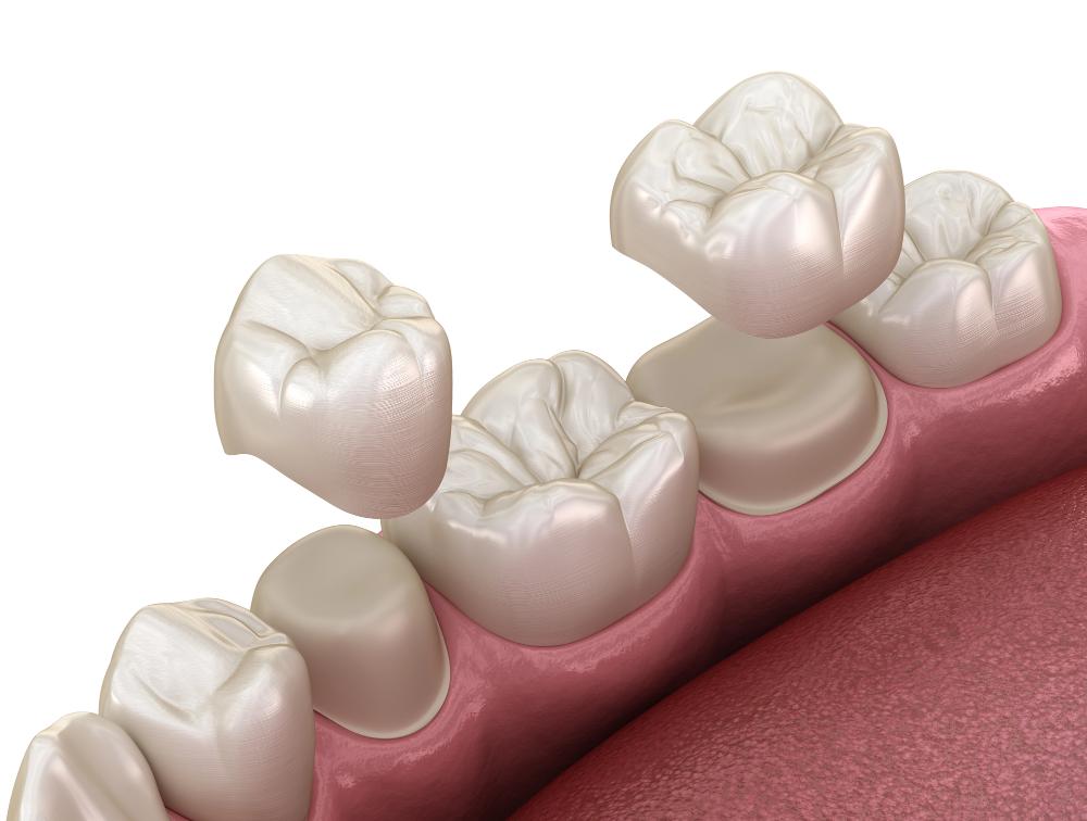 Can You Eat After Getting A Dental Crown?