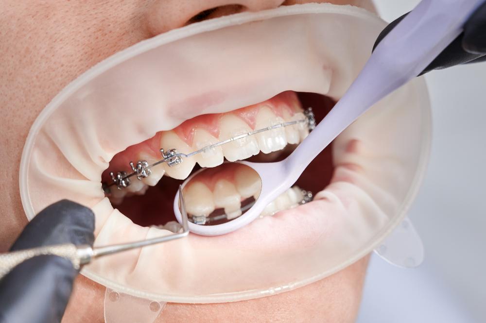 Can You Get A Dental Cleaning With Braces On?