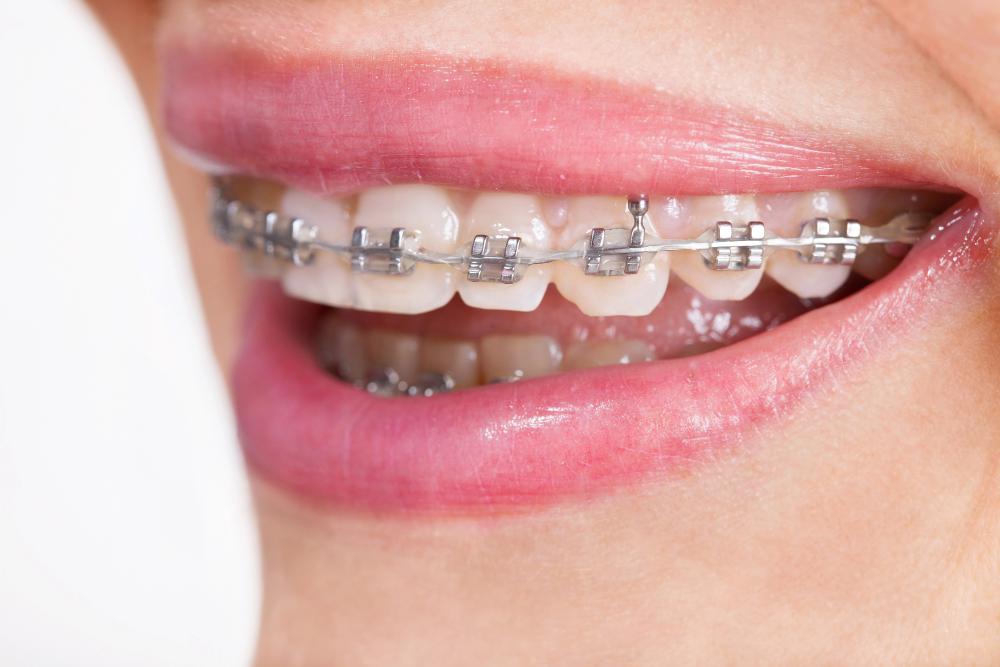 Can You Get Braces If You Have Cavities?