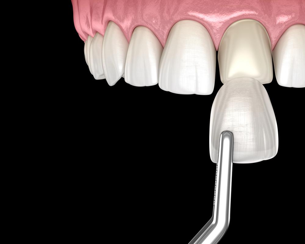 Can You Get Veneers For Just Two Front Teeth?