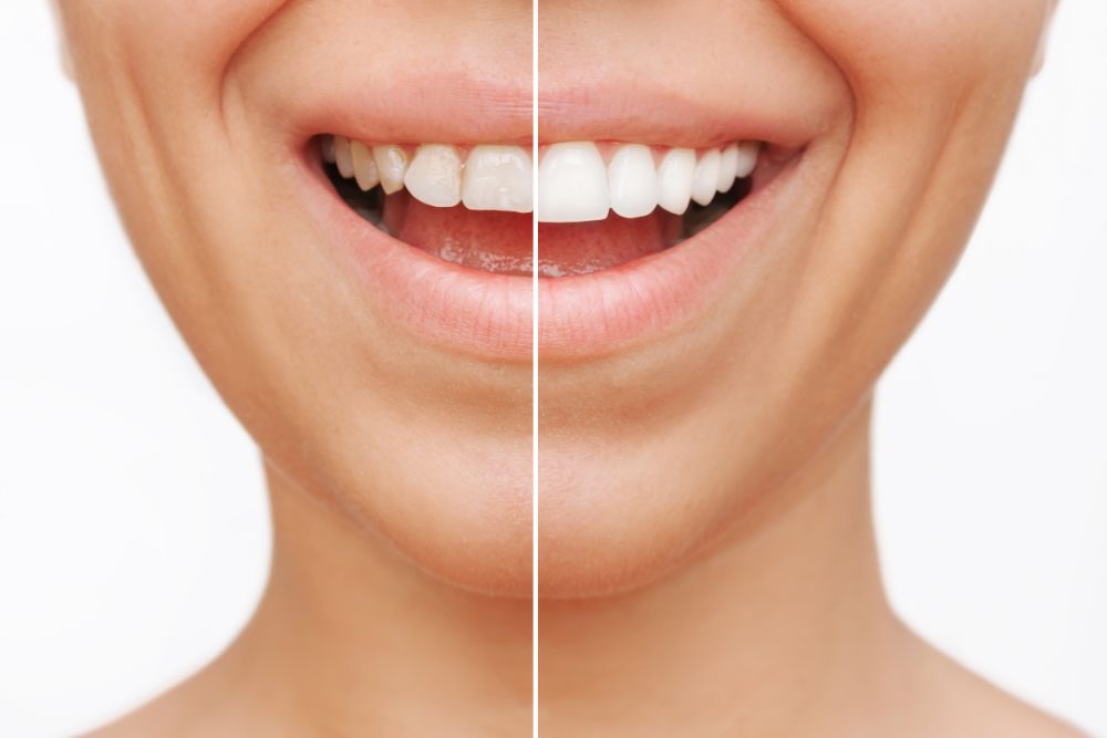 Can You Get Veneers With Missing Teeth?