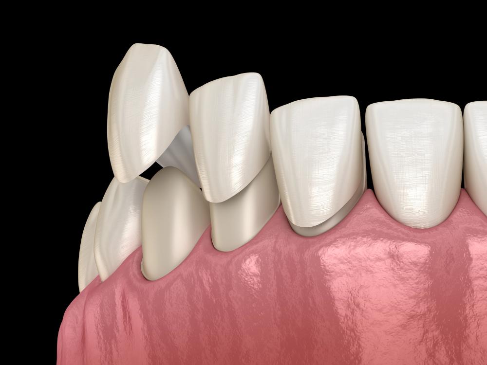 Can You Put A Veneer Over A Crown For Better Aesthetic Results?