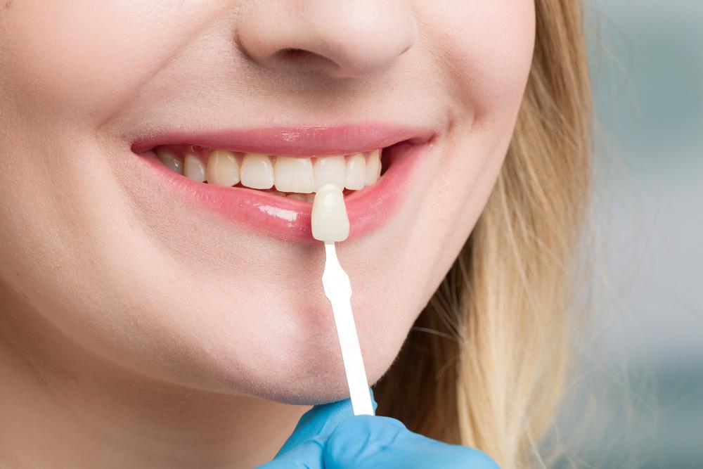 Can You Still Get Veneers If You Grind Your Teeth?