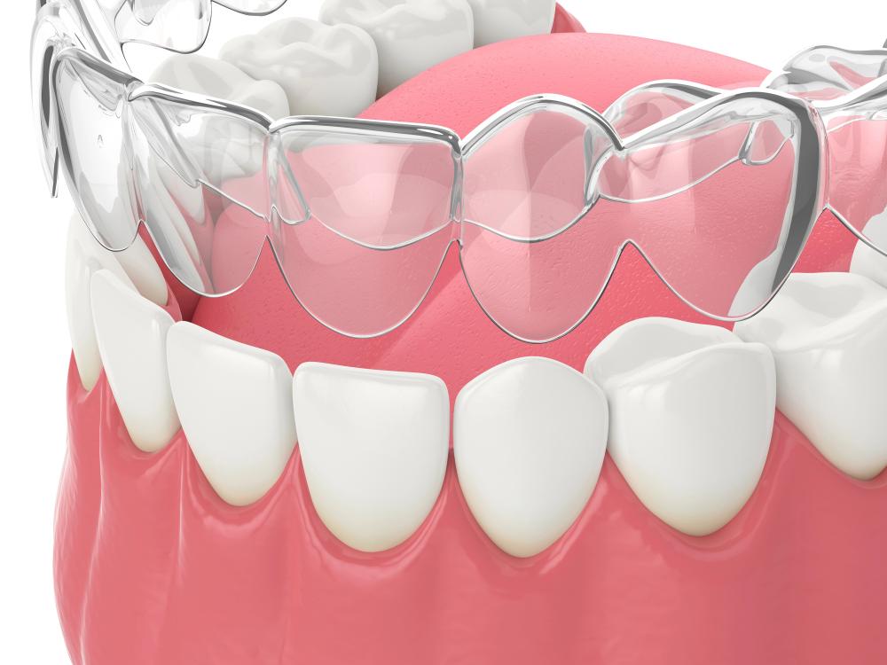 Can You Wear Invisalign Only At Night?