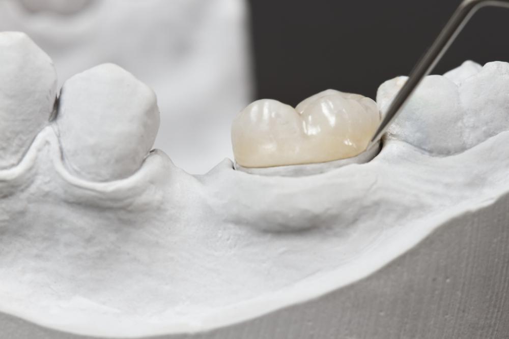 Can You Whiten A Dental Crown?