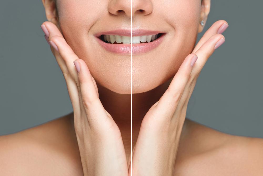 Can You Whiten Bonded Teeth?