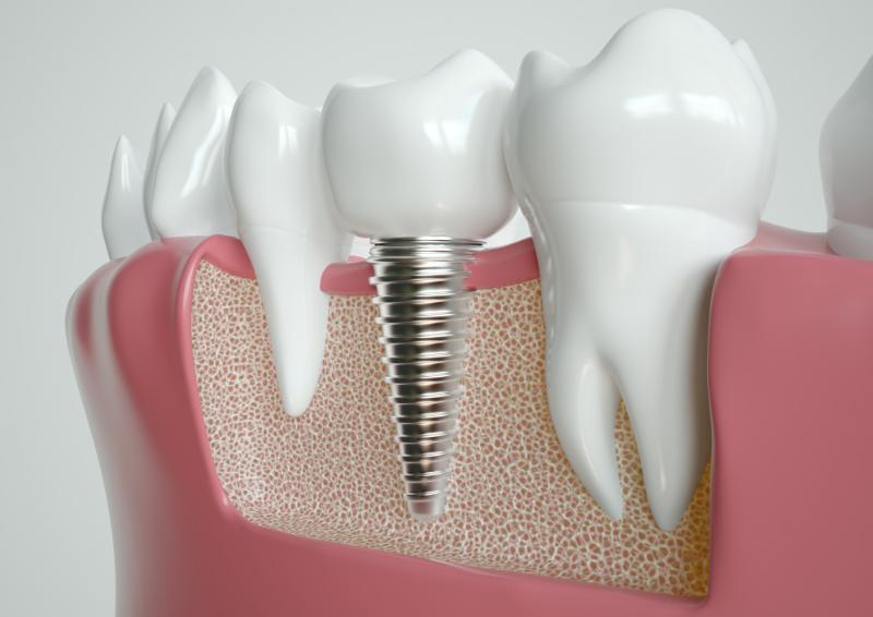 can you whiten dental implants