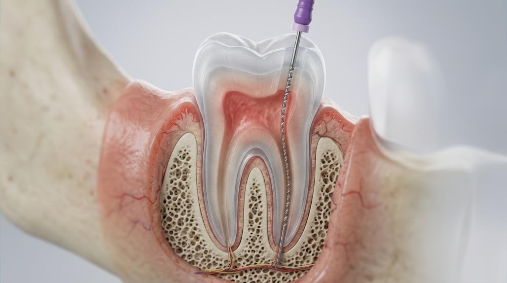 Can You Work After A Root Canal?