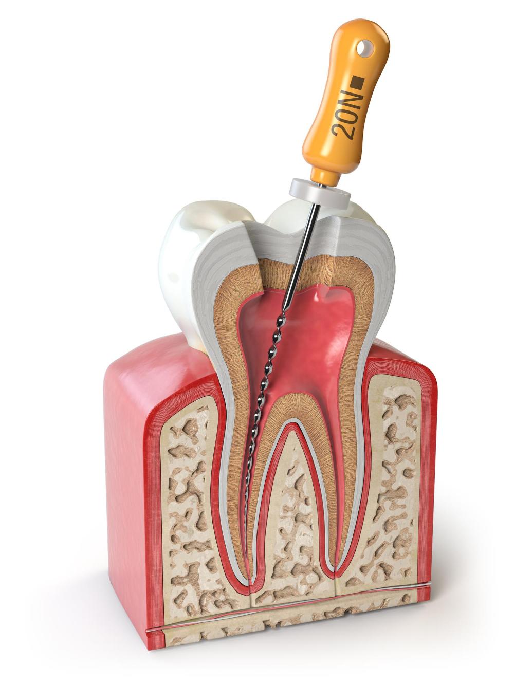 Cavities Vs. Root Canal: Which Treatment Do You Need?