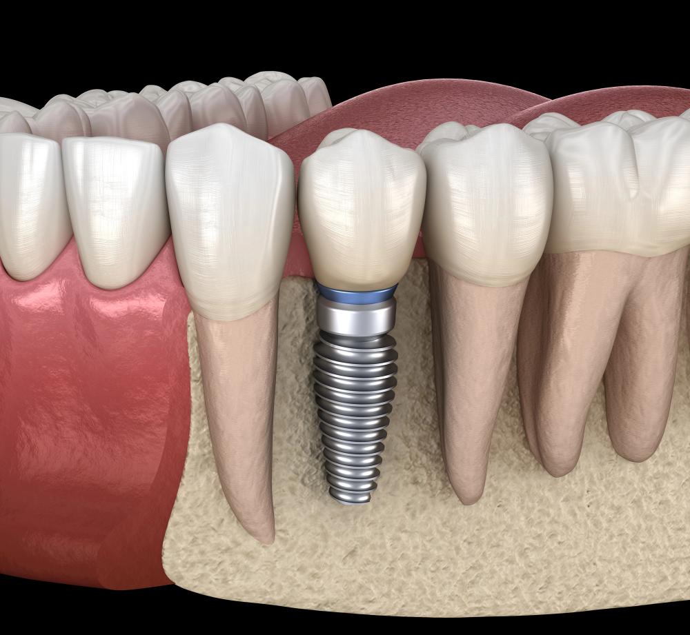 Ceramic Vs. Titanium Dental Implants: What’s The Difference?