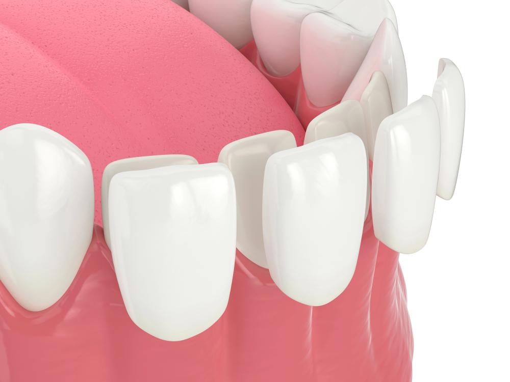 Choosing Between Porcelain Veneers And Traditional Braces