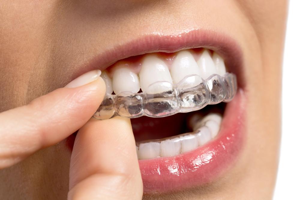 ClearCorrect Vs. Invisalign: Are The Results Really The Same?