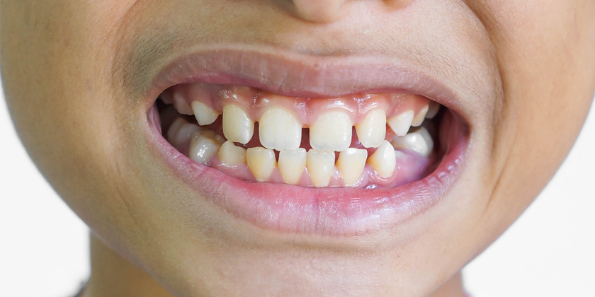 Closing Gaps In Teeth Without Braces