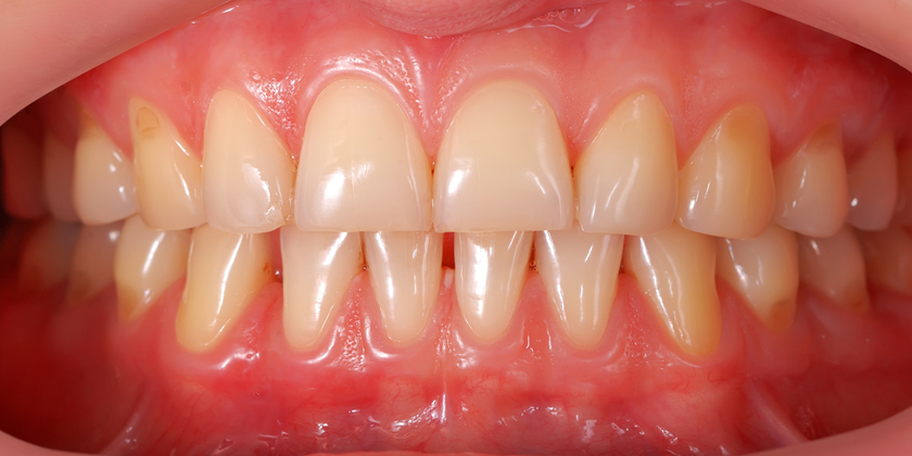 Common Causes Of Dark Gums