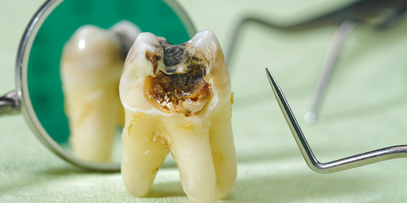 dental caries