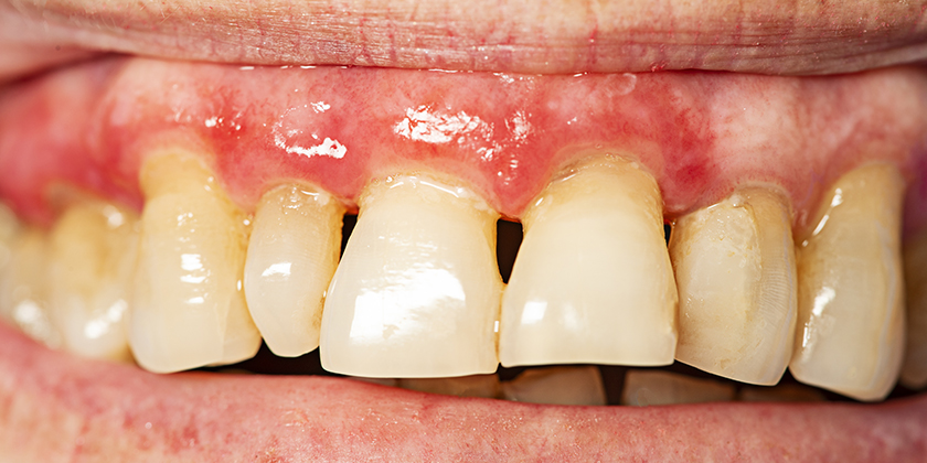 Common Causes and Treatment of Periodontal Disease