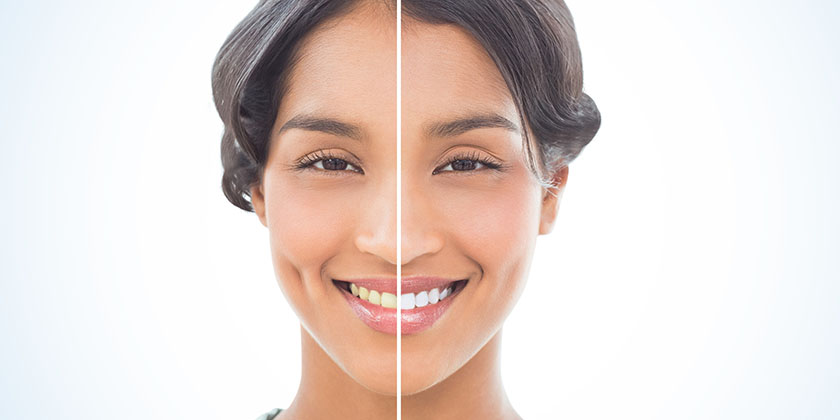 Common Cosmetic Dentistry Myths That You Should Never Believe