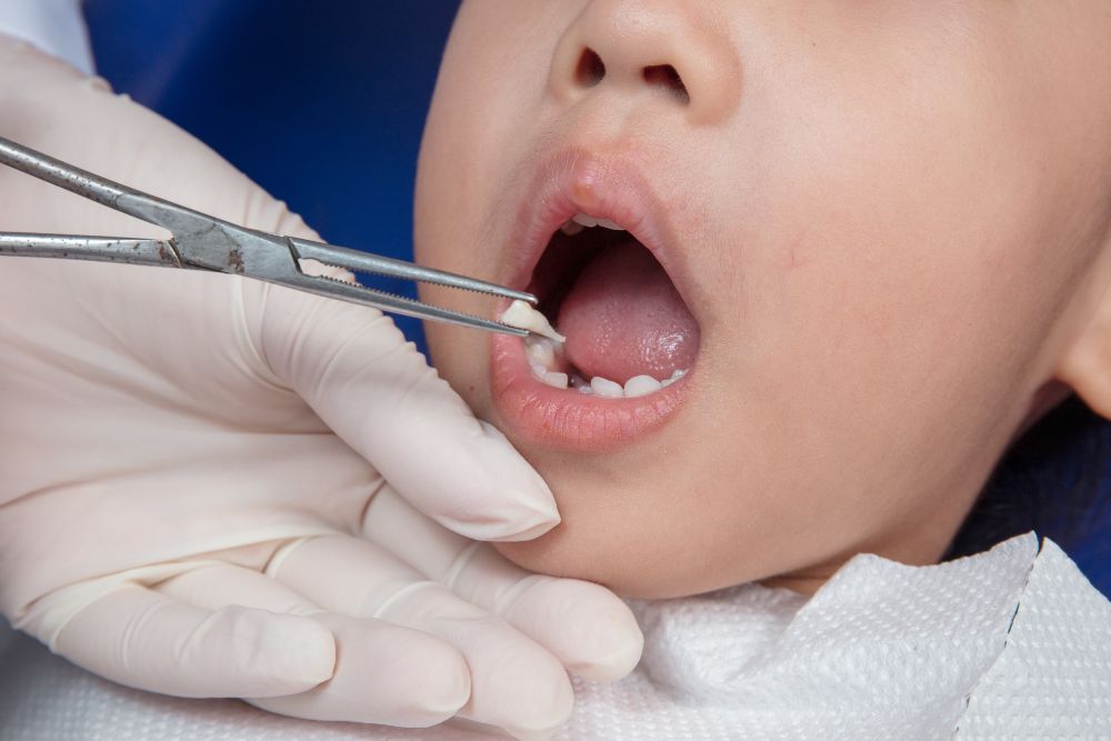 Common Situations That Require A Tooth Extraction