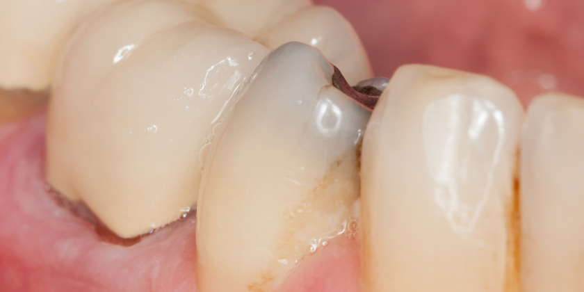 Comparing Composite Fillings Versus Amalgam