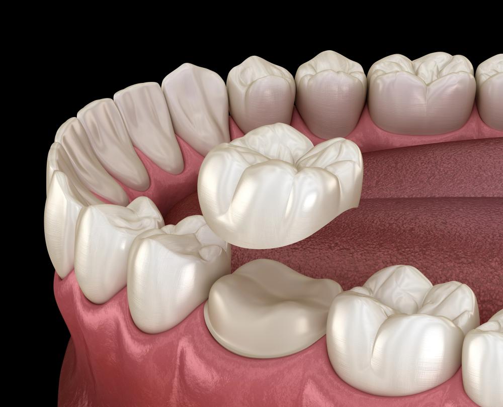 Crowns Vs. Dental Implants: Which Is The Better Choice?