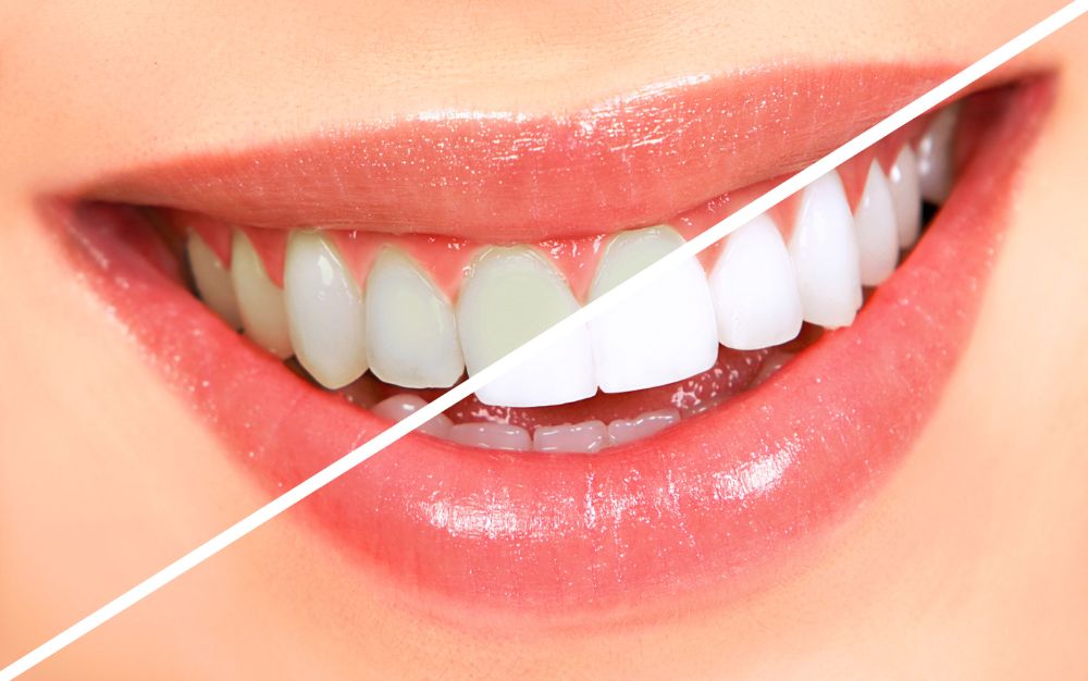 Debunking Four Most Common Teeth Whitening Myths