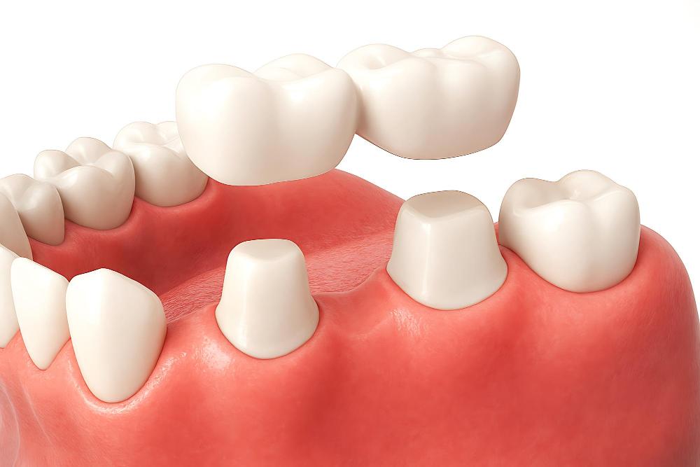 Dental Crown Warranty Explained