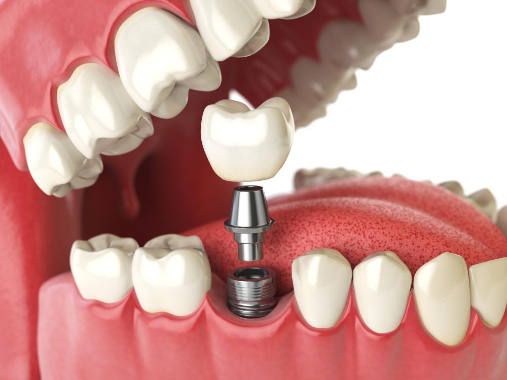 Dental Implants Vs. Veneers: Selecting The Ideal Treatment