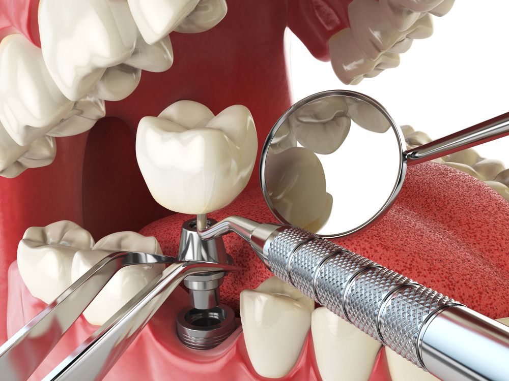 Full Mouth Dental Implants: What You Need To Know